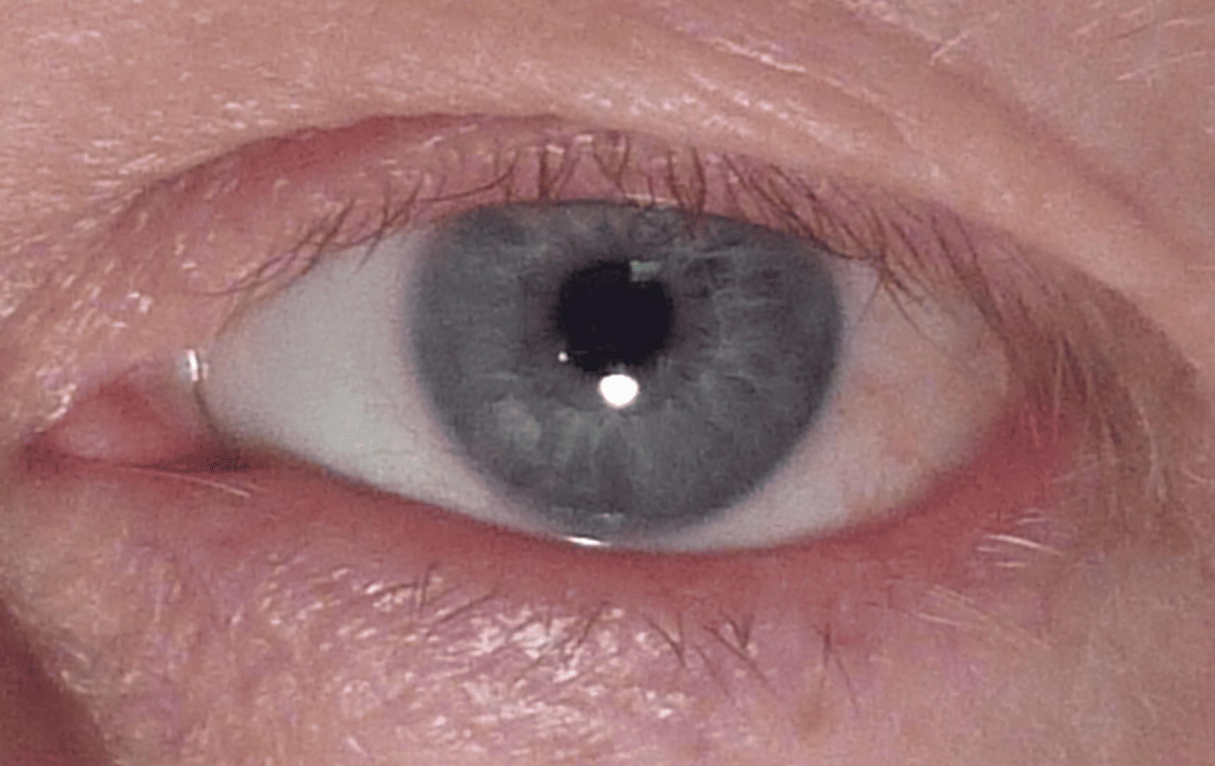 Pinguecula Removal with WhiterEyes® for Improved Confidence