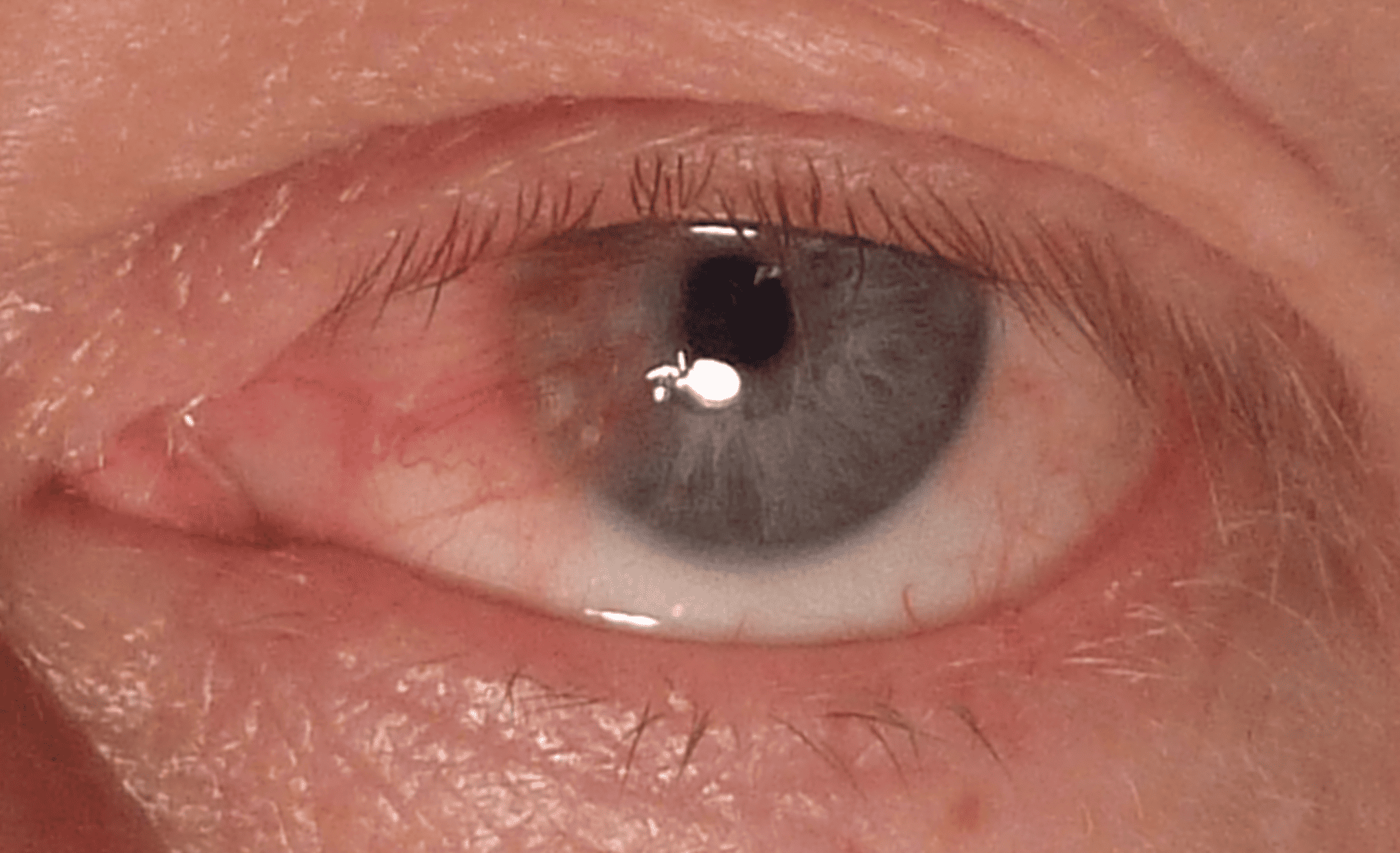 Pterygium Removal withWhiterEyes® for Improved Confidence