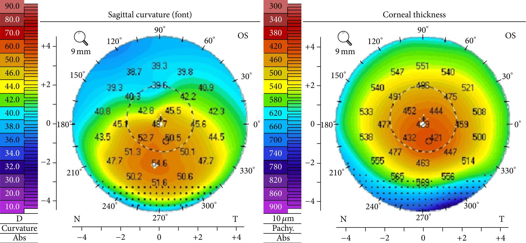 Keratoconus Surgery Los Angeles Yebaran