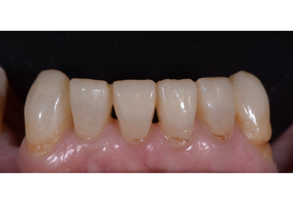 Fixed & Removable Prosthodontics BPI Dental