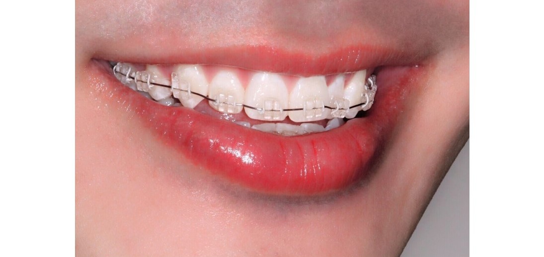 Ceramic, Metal and Transparent Teeth Braces in Singapore MEOC