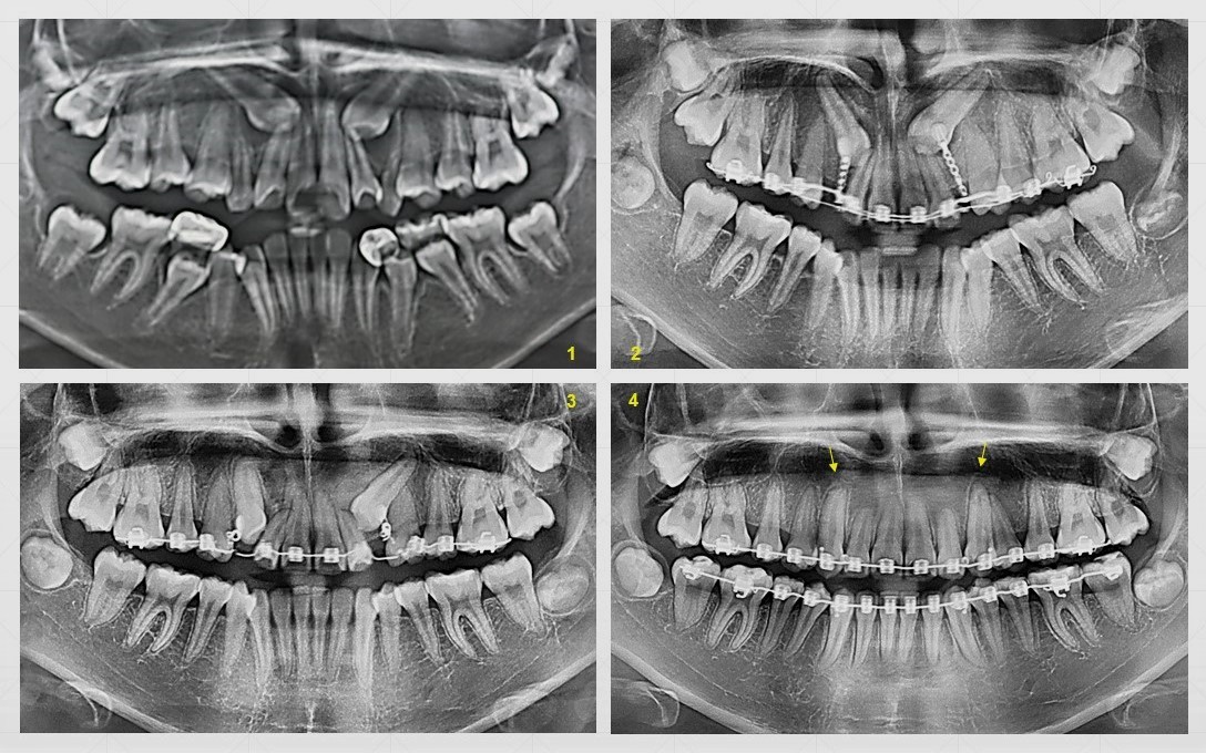 Impacted Teeth Mount Elizabeth Orthodontic Clinic