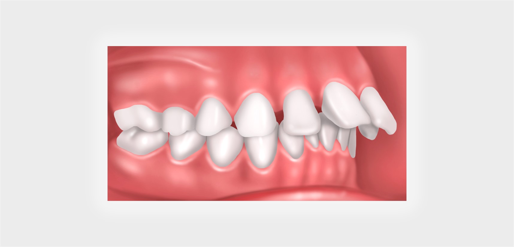 Protrusion (OverJet) Mount Elizabeth Orthodontic Clinic