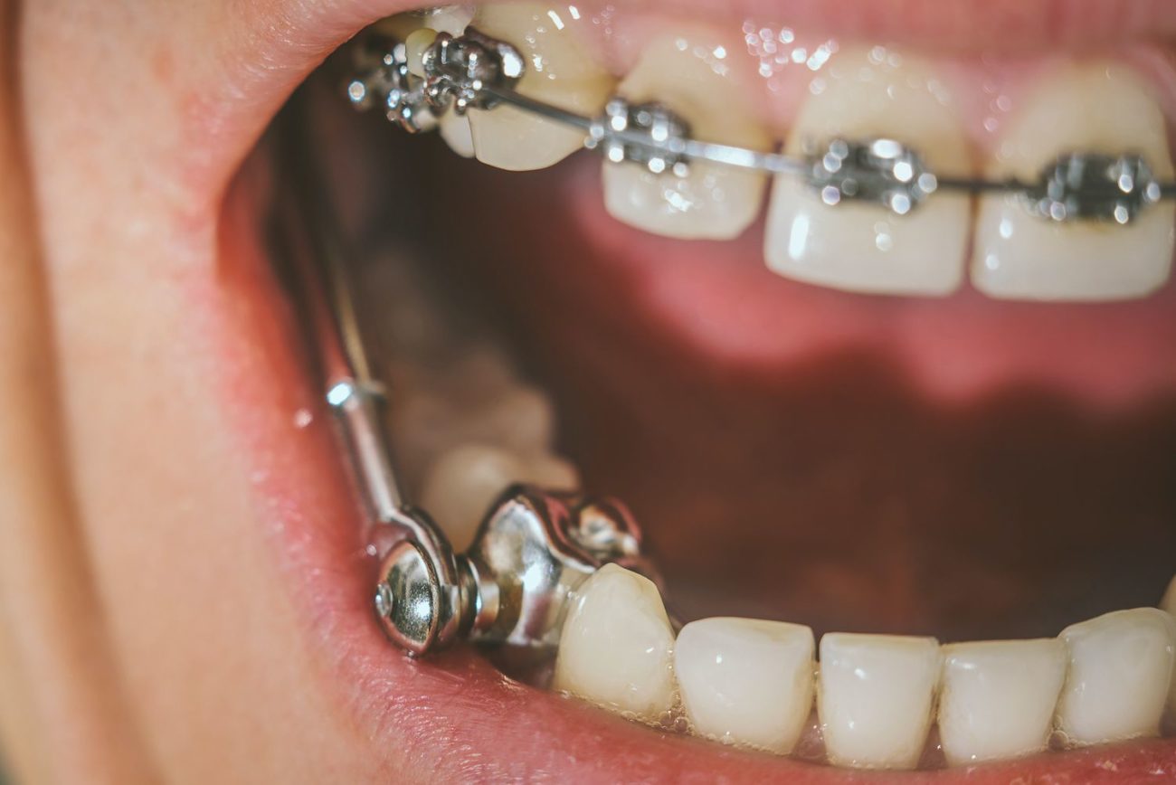 Do I Need an Orthodontic Appliance? Cockeysville, MD Orthodontist