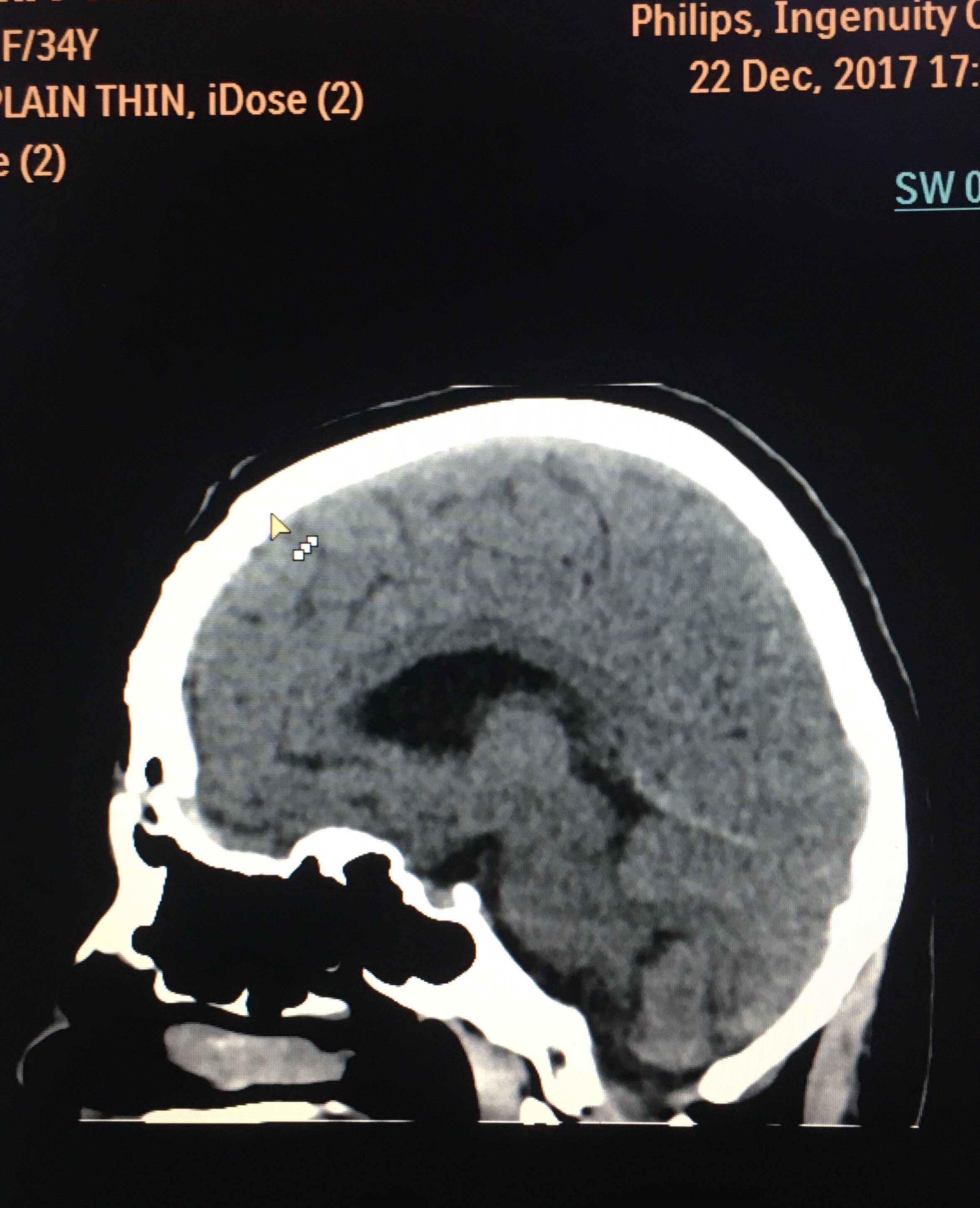 Skull base surgery for brain tumor Brain & Spine Surgery Centre