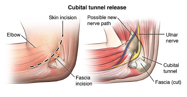 Ulnar Nerve at the Elbow Westmead, NSW