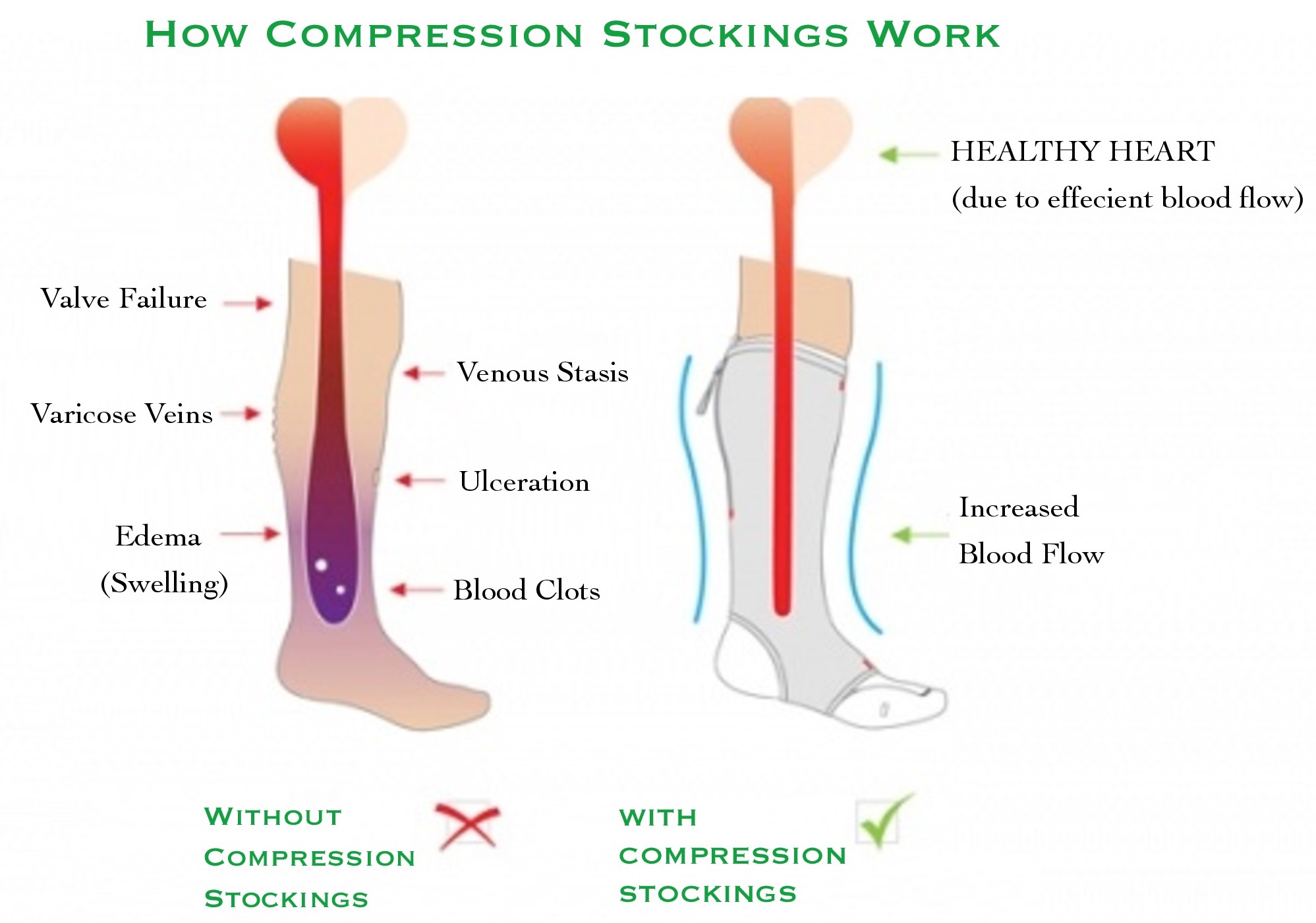 Compression Stockings Brampton Foot Clinic