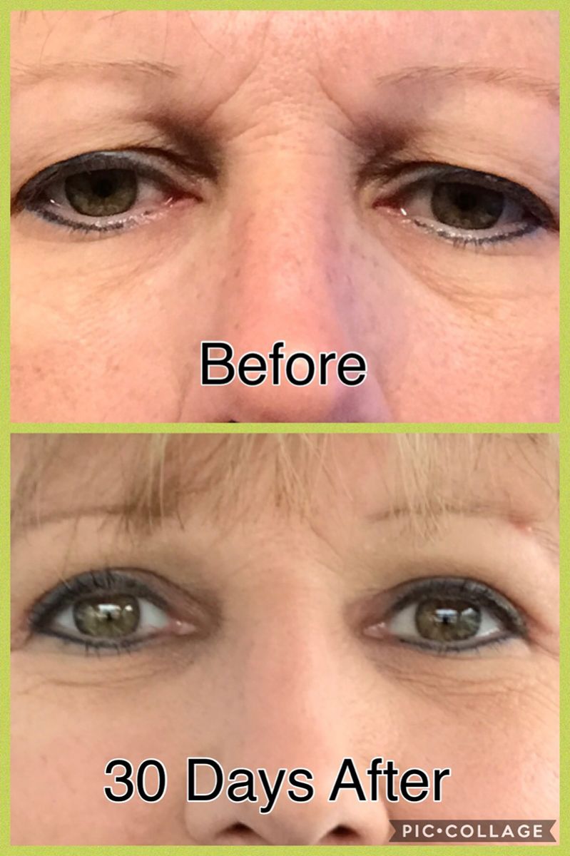 Eye Lid Surgery Eye Doctor In Brandon, FL Brandon Eye Associates