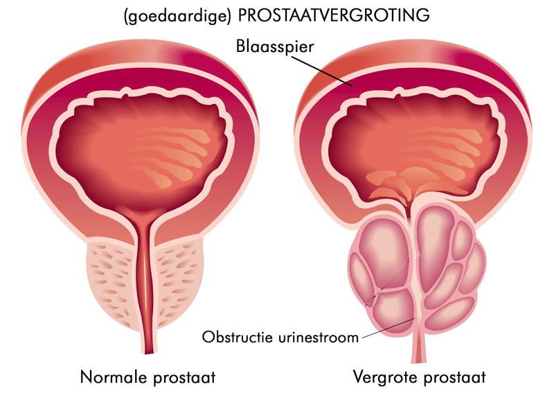 Vergrote Prostaat
