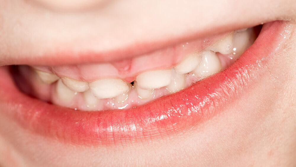 3 Surprising Ways That Breast Milk Affects Your Childs Teeth