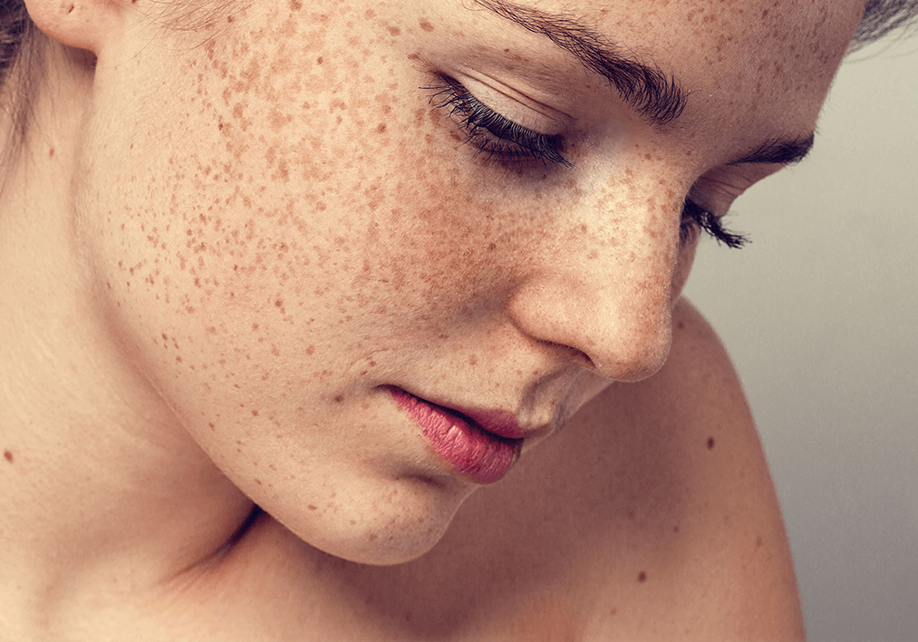Does Red Light Therapy Make Melasma Worse?