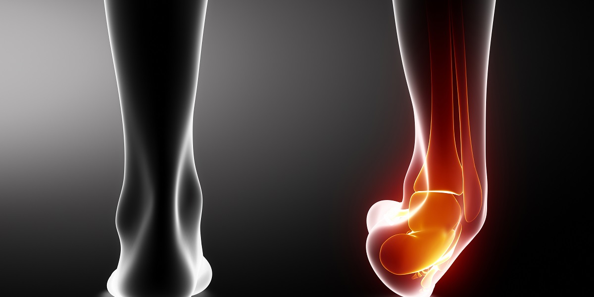 Everything You Need To Know About Ankle Sprains