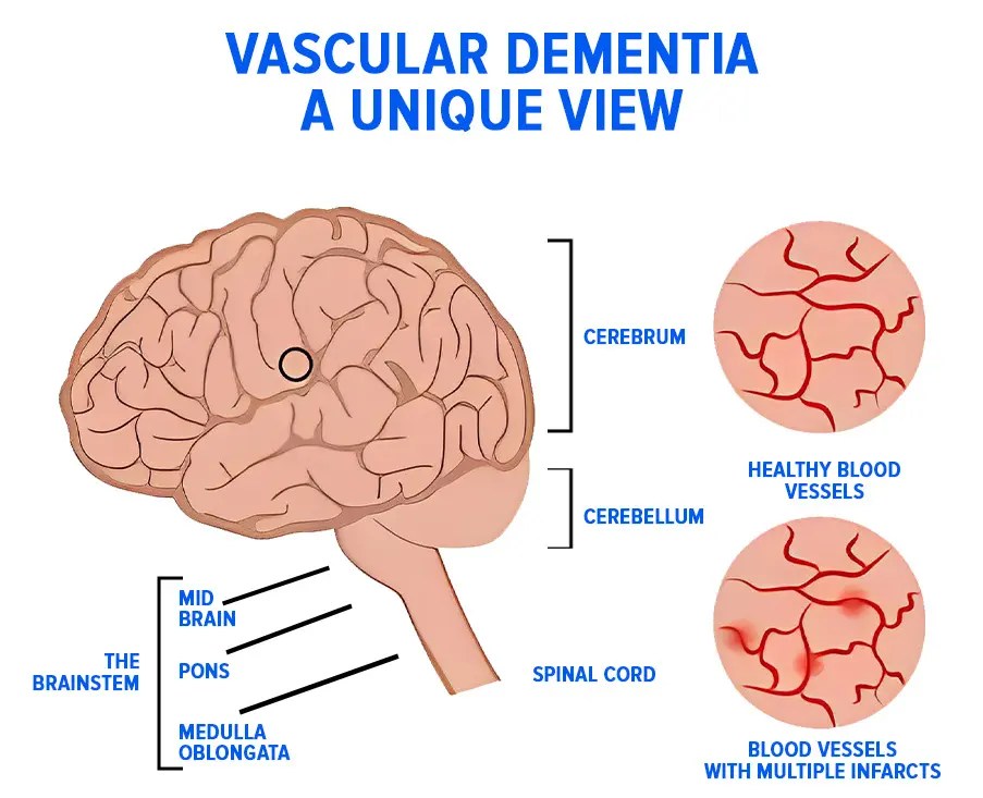 New Treatments For Vascular Dementia Discover Right Solution