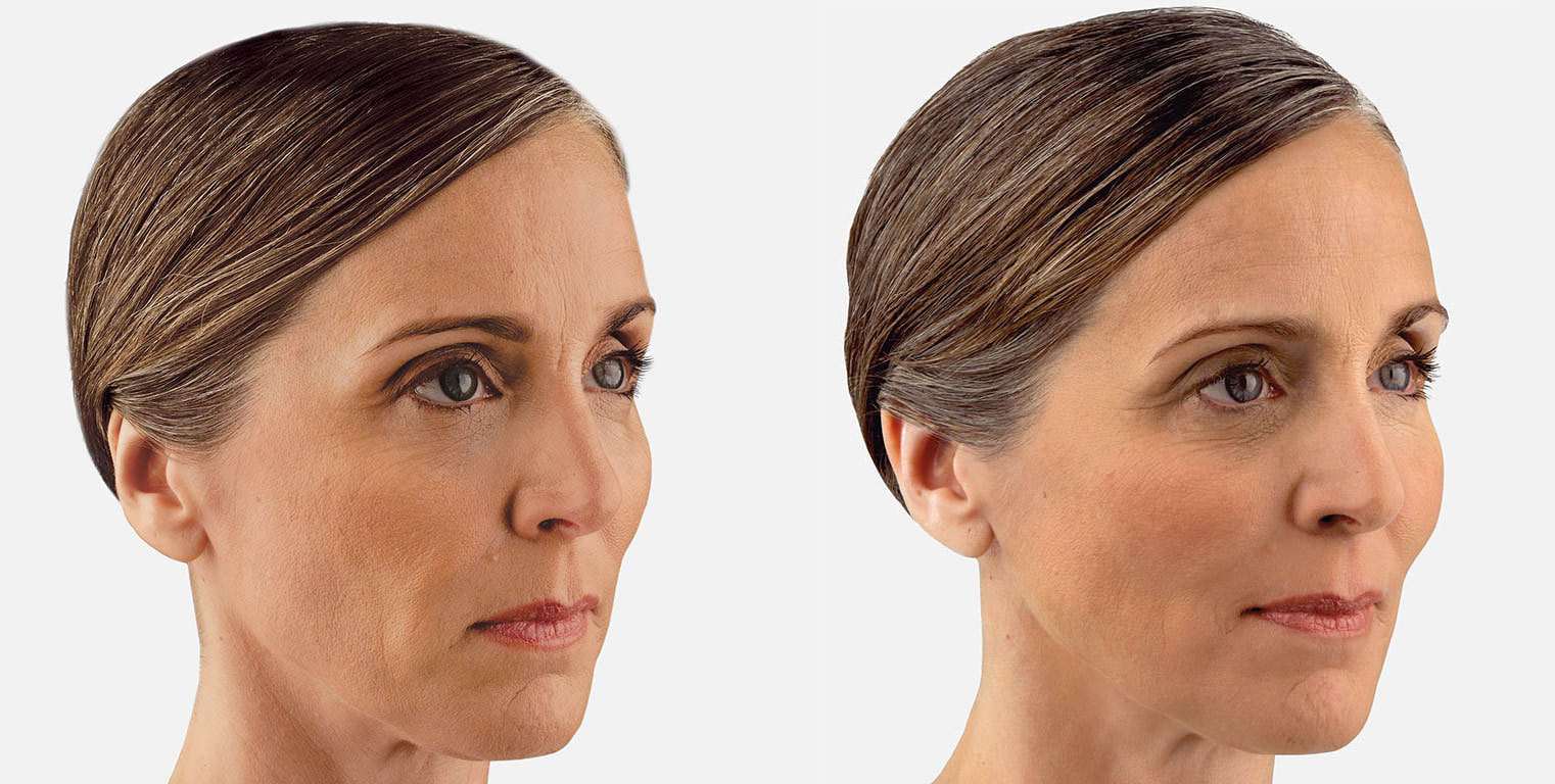 Dermal Fillers Rodgers Center for Plastic Surgery