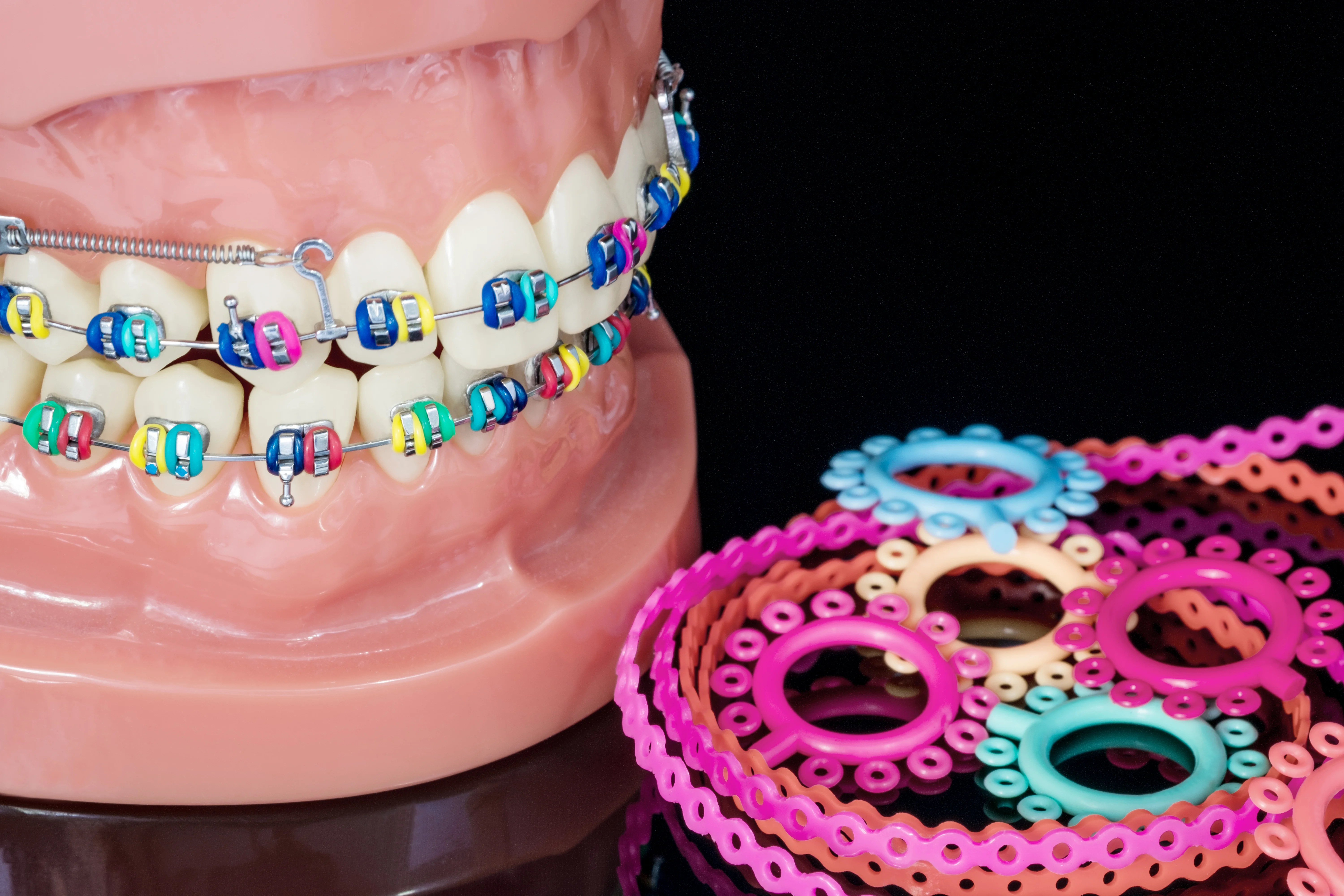 Exploring Brace Types A Comprehensive Guide