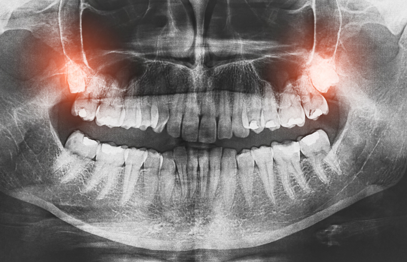 Do You Need Wisdom Teeth Removal? Mountain Aire