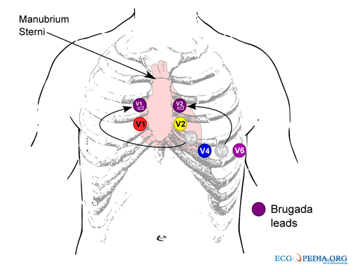 Pediatric Ekg 15 Lead Placement Diagram Wiring Diagram