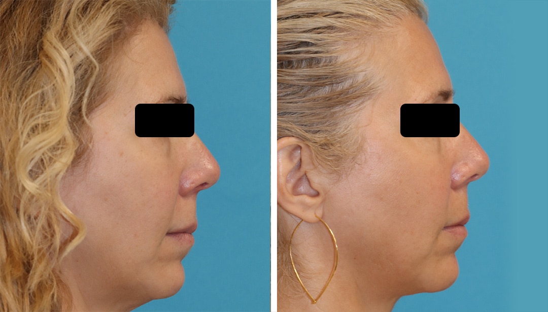PrecisionTx facial contouring before and after results in Princeton