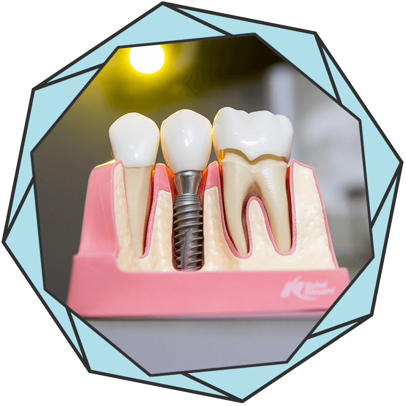 Dental Implants Boca Raton, FL Brush Dental
