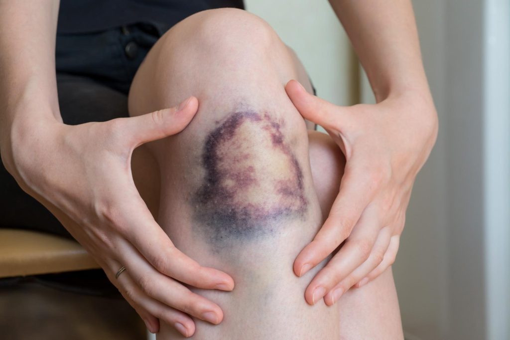 Can Soft Tissue Damage Be Permanent? Get Informed Now