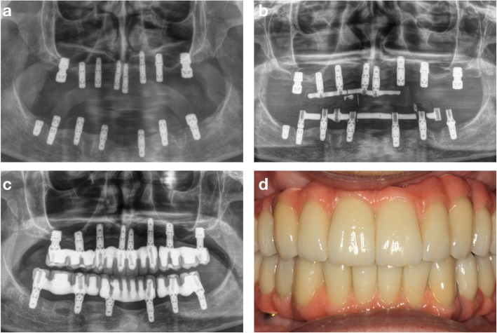 Performance of the countertorque technique in the