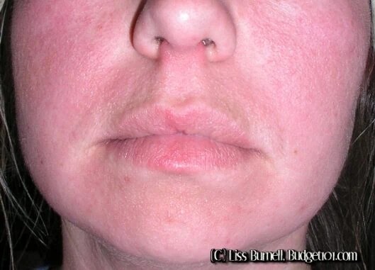 Cow Itch Vine Rash Treatment All About Cow Photos