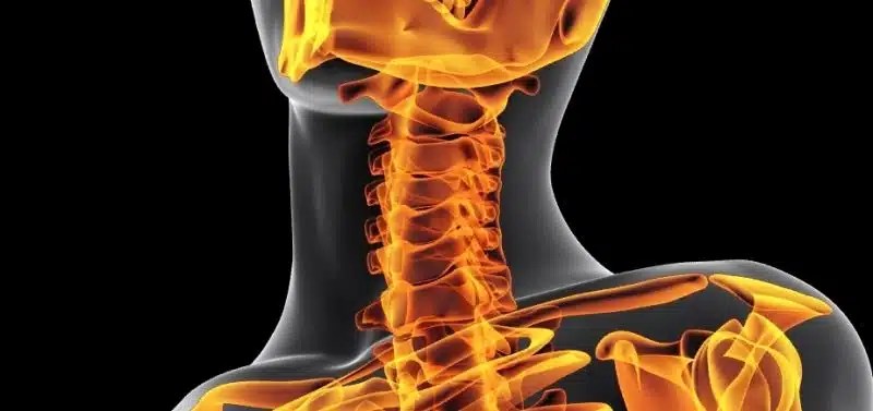 Artrosis Cervical Incapacidad Laboral. Preguntas y respuestas
