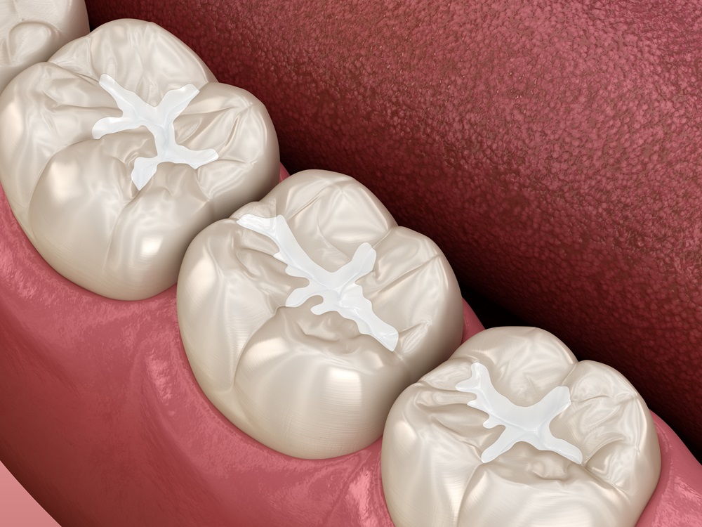 How Long Does it Take for Composite Fillings to Settle?
