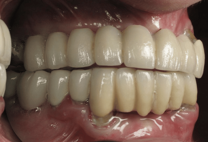 Prettau Dental Implant Full Mouth Bridge Alternative to Allon4