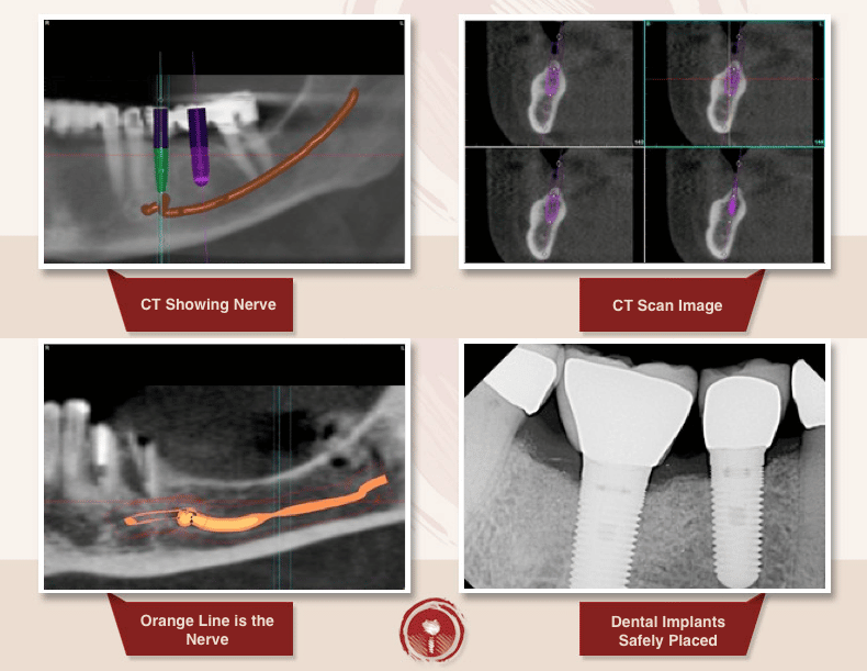 Dental Implants Los Angeles Area Implants Dentist Ramsey A. Amin, DDS