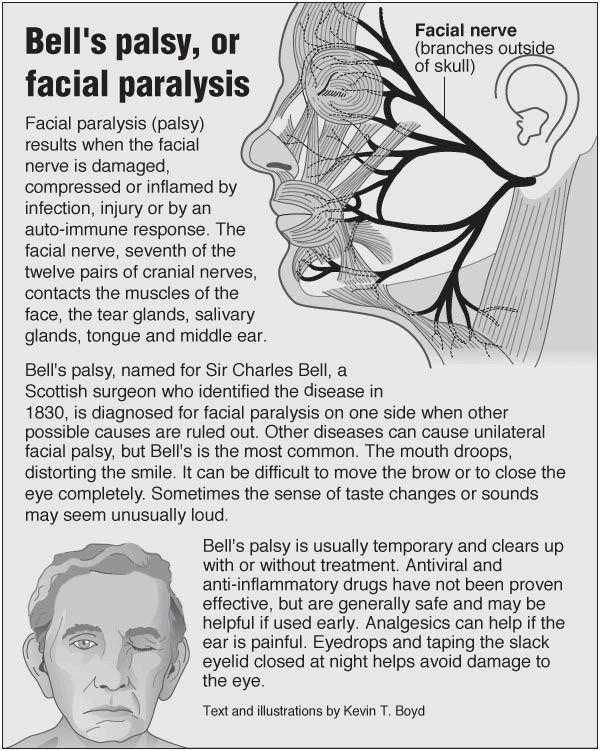 My Personal Bell's Palsy Journey