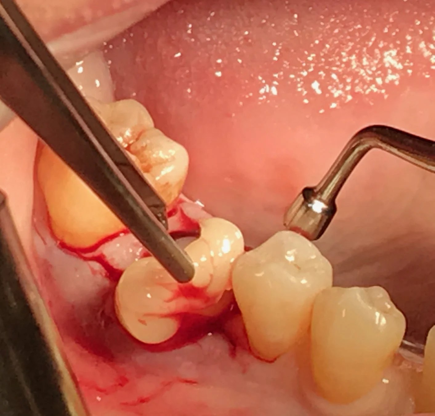 LPRF® Techniques & Applications New City NY, BWS Seminars