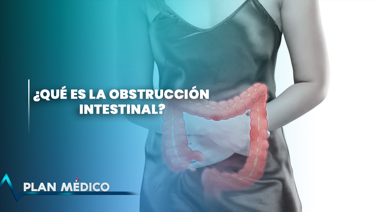 ¿Qué es la obstrucción intestinal? Plan Médico