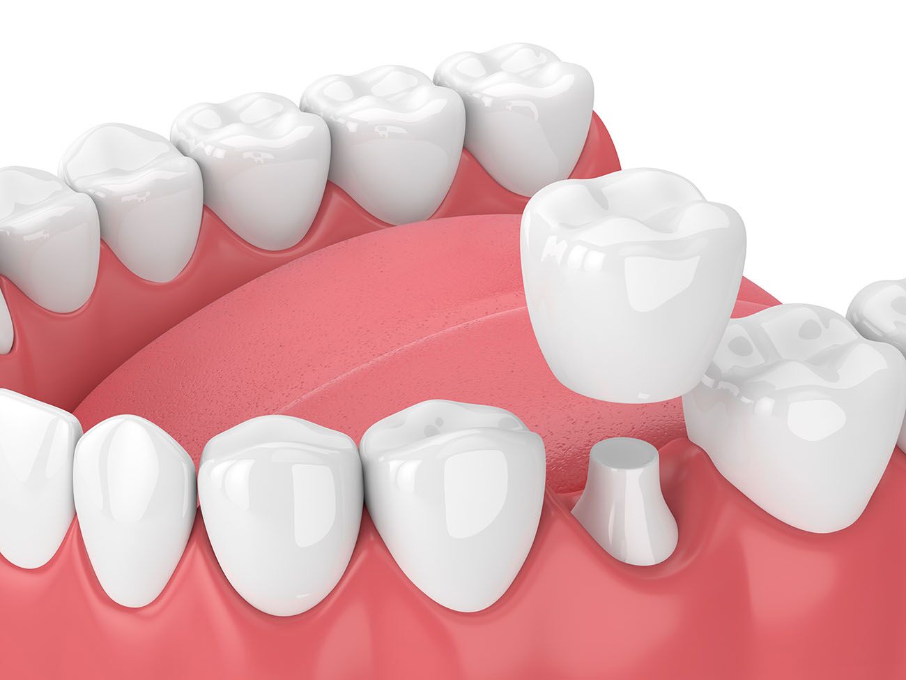 What Problems Can be Fixed by Dental Crowns? Ohio Dentist