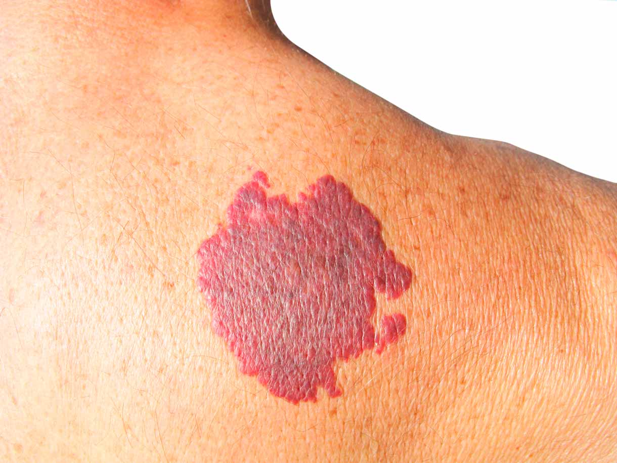 Campo OptimageAngiomas y malformaciones vaculares