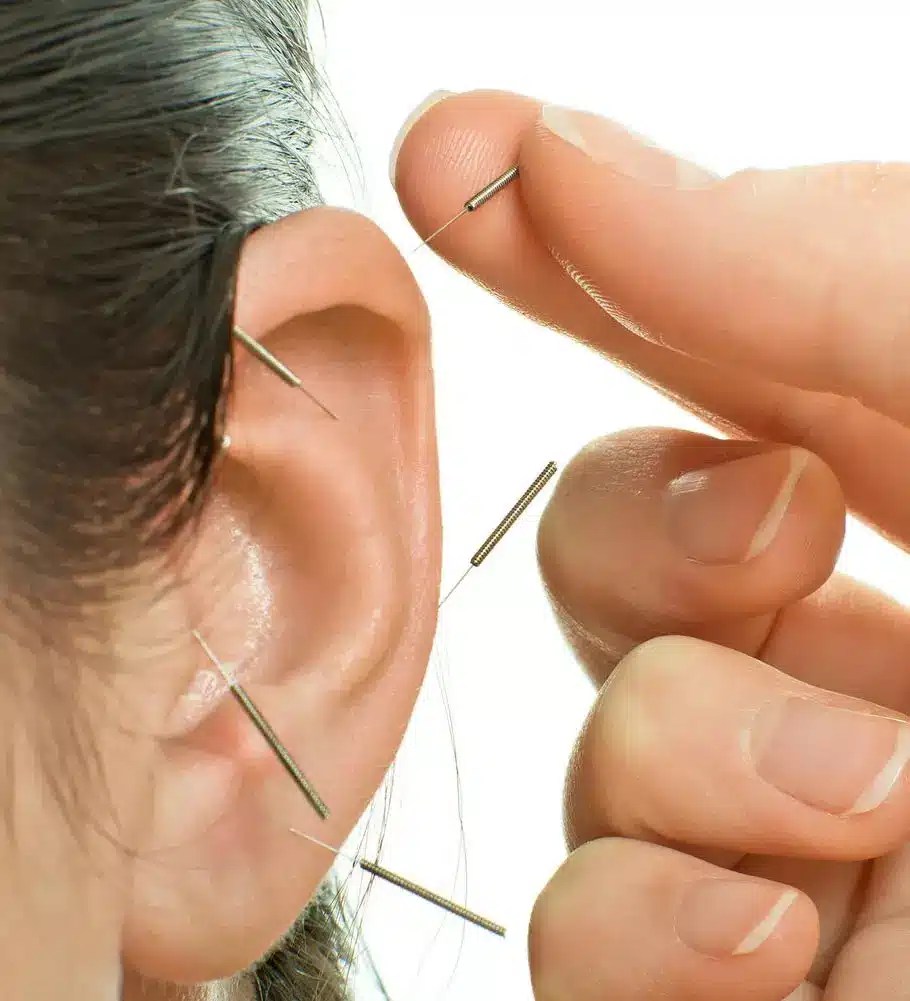 Auricular Acupuncture Integrative Medicine and Cannock Acupuncture