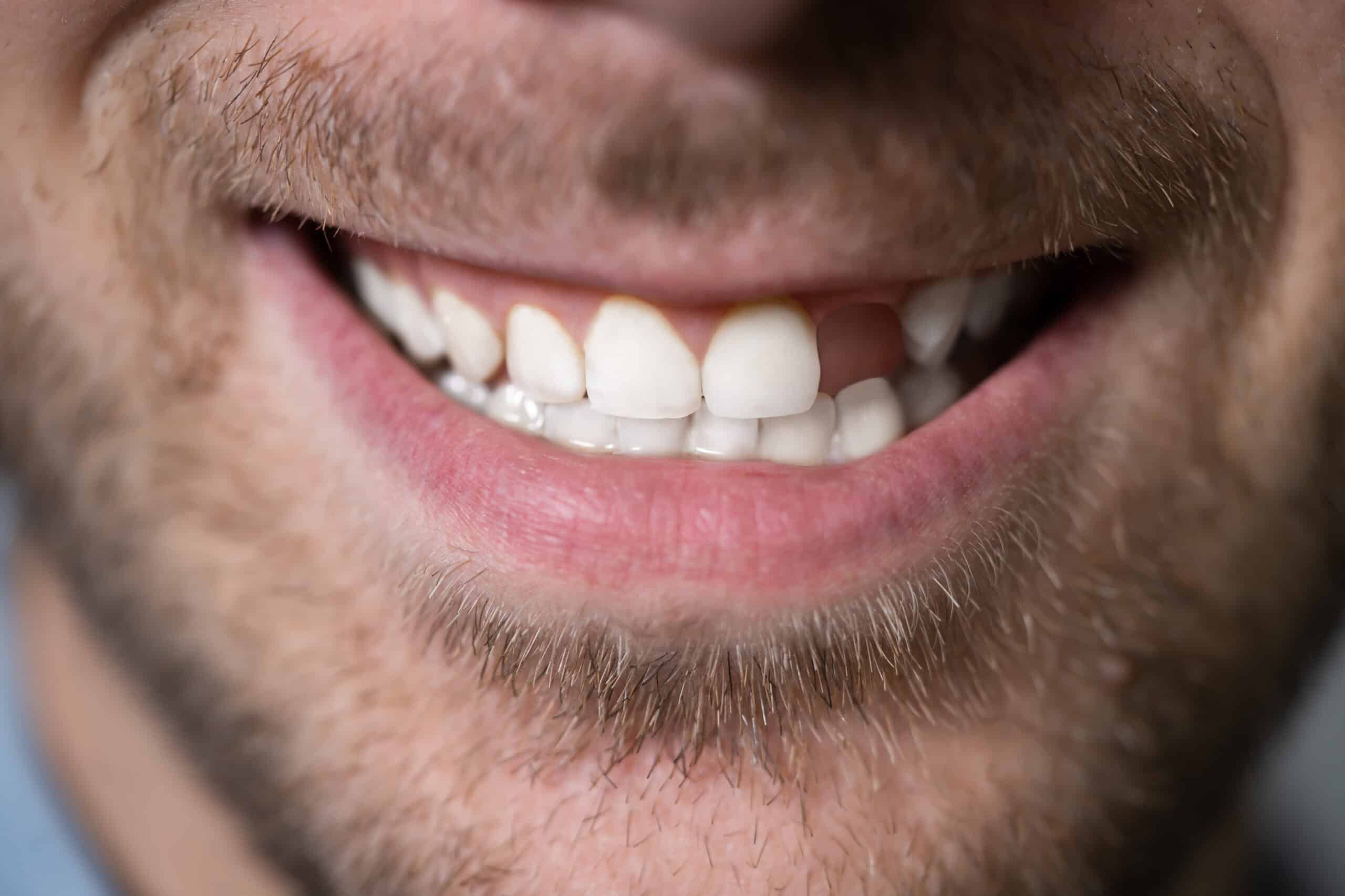 Can missing teeth change my facial shape or make me look aged? Can missing teeth change my facial shape or make me look aged?
