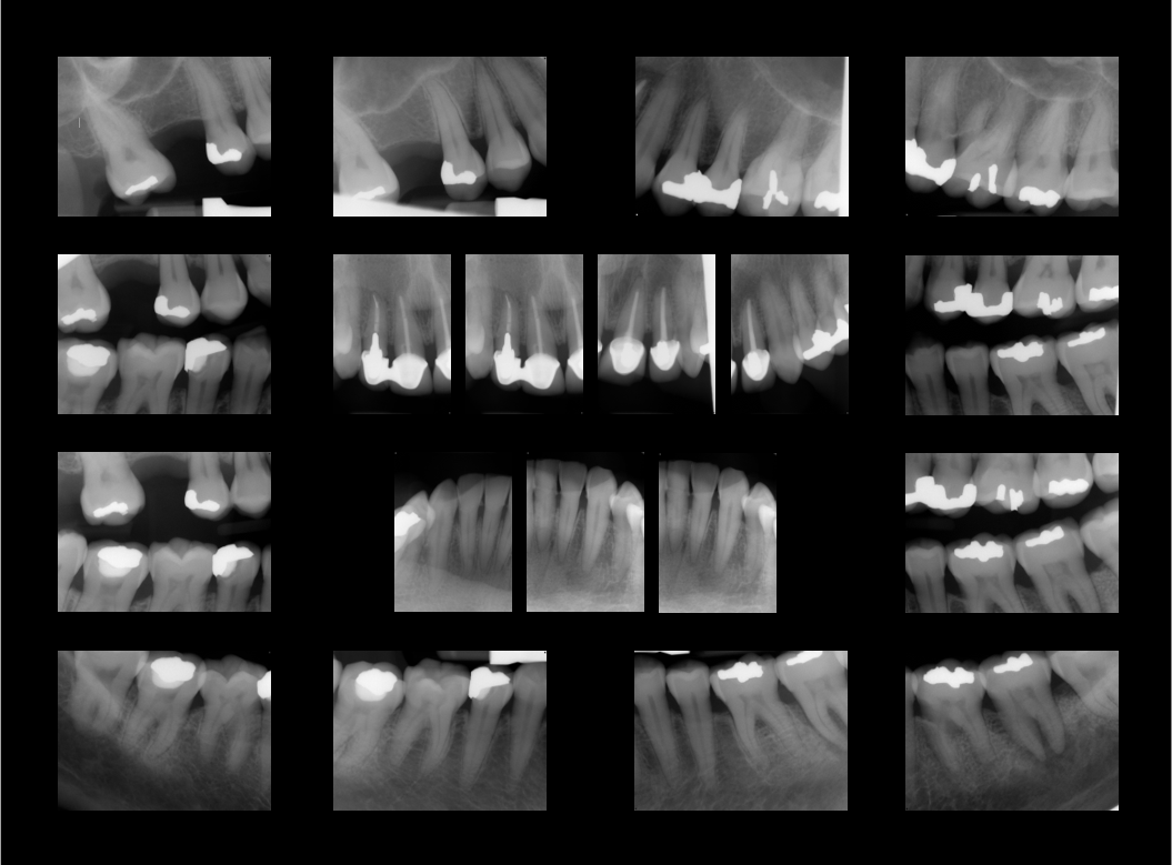 Intraoral Radiographs Capture 3D Radiology