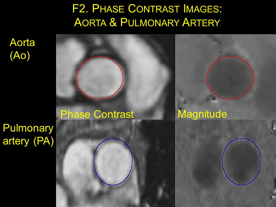 Aortic regurgitation Cardiac MRI