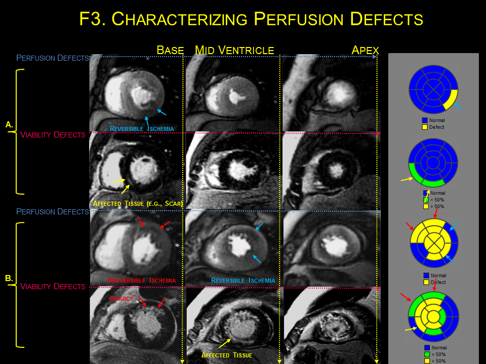 What Is A Mri Cardiac Stress Perfusion Test at Justin Jennings blog