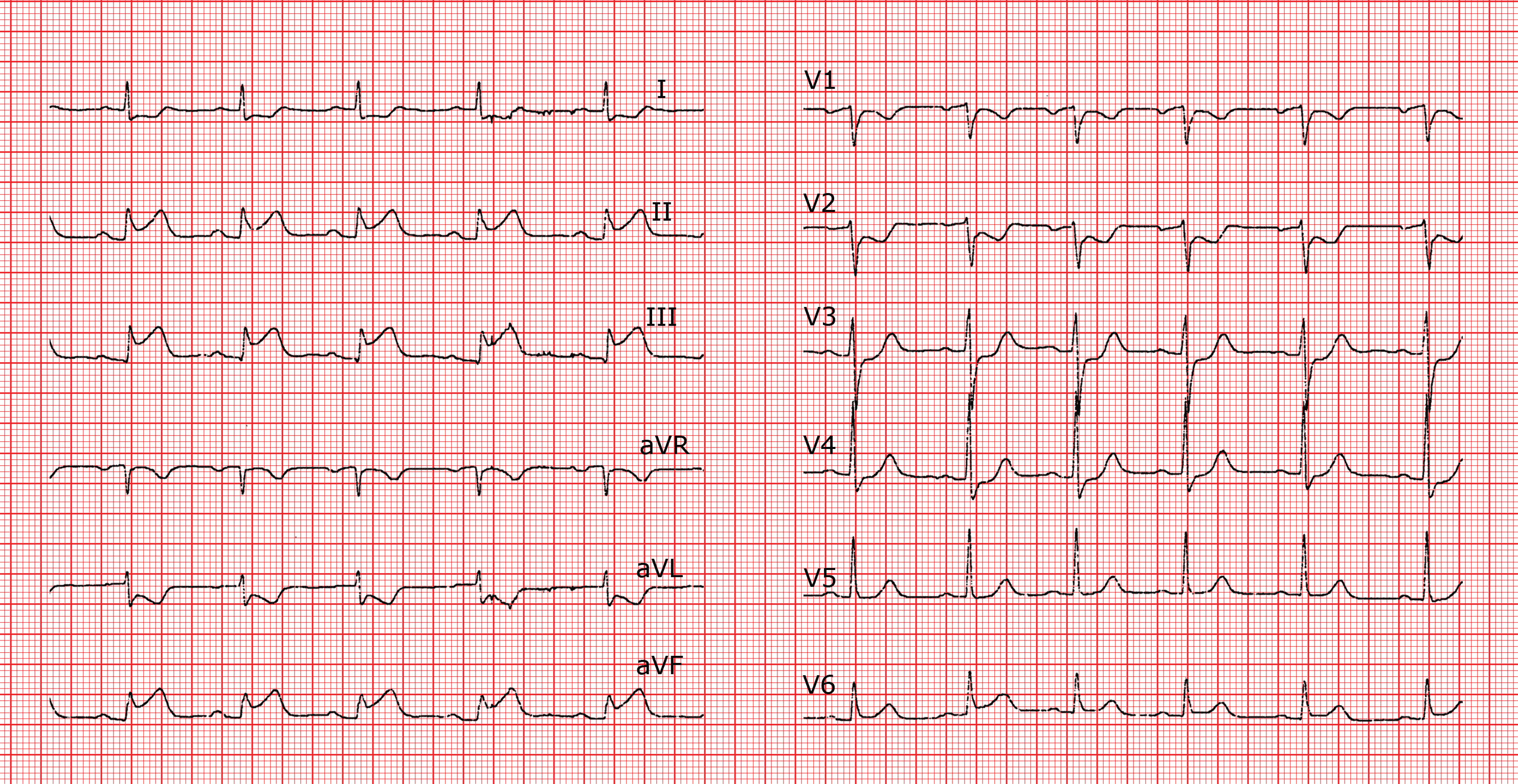 [CardioFR] Die Lokalisation der Ischämie