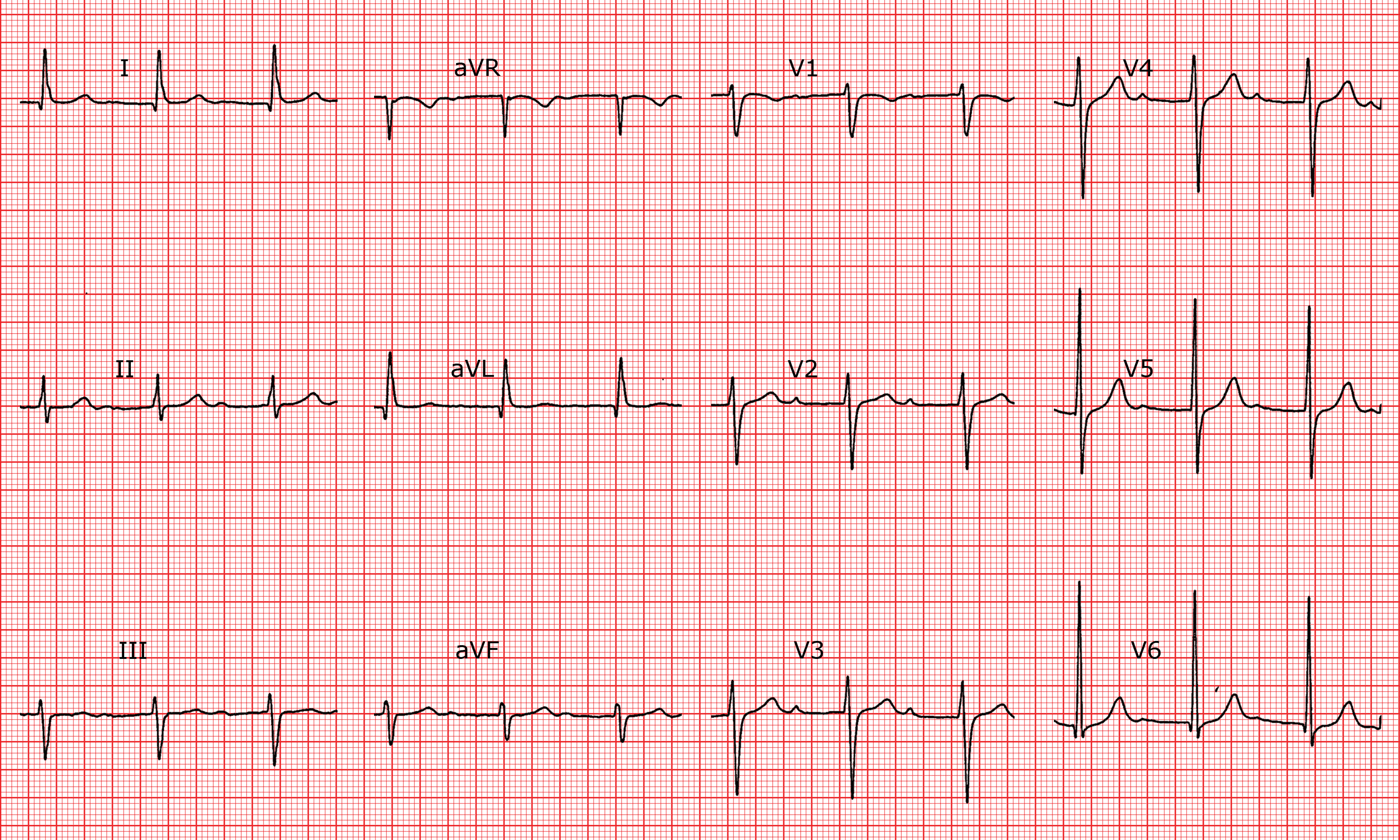 [CardioFR] Bloc AV du 1er degré.