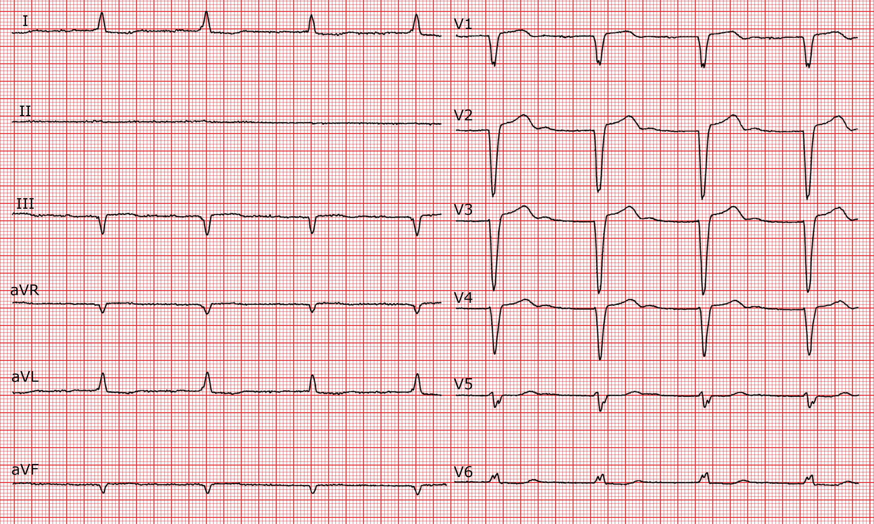 [CardioFR] Linksatrialer Rhythmus. AVBlock ersten Grades