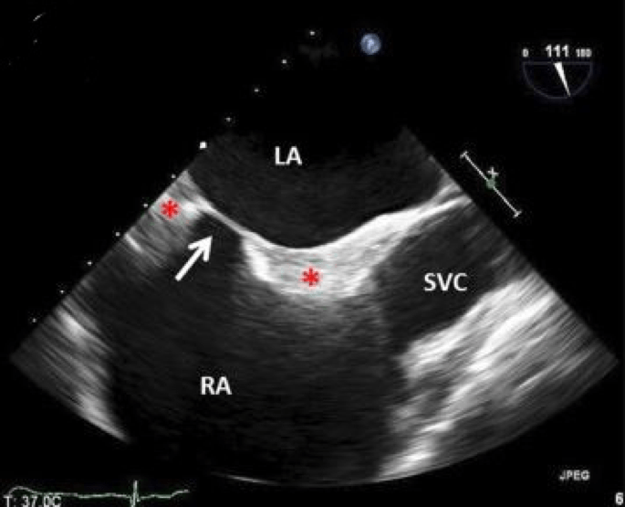 Icd 10 Hypertrophic Cardiomyopathy Areasto za