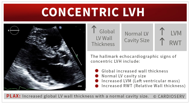 Understanding LVH Part 1 Concentric, Eccentric and Concentric Remodeling