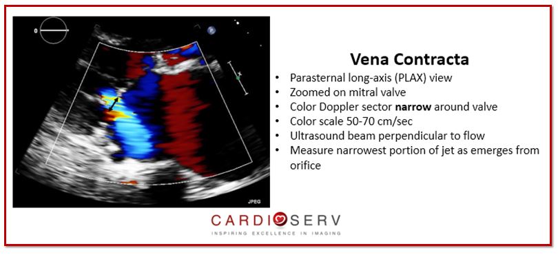 3 Essential Color Doppler Measurements for MR