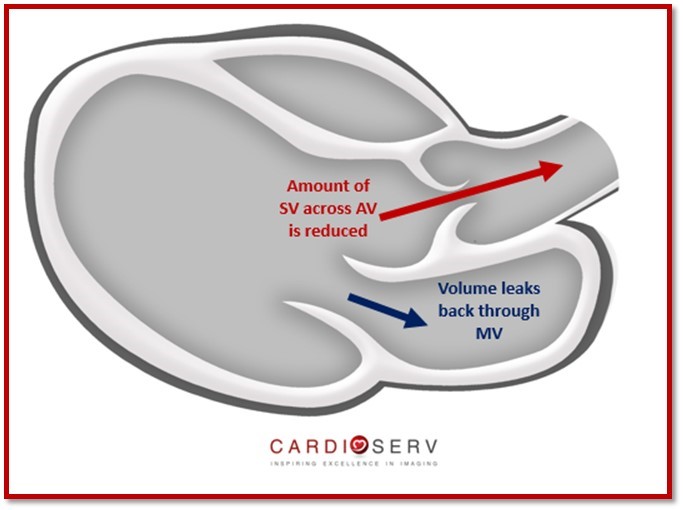 3 Steps to Quantifying MR via Stroke Volume Method!