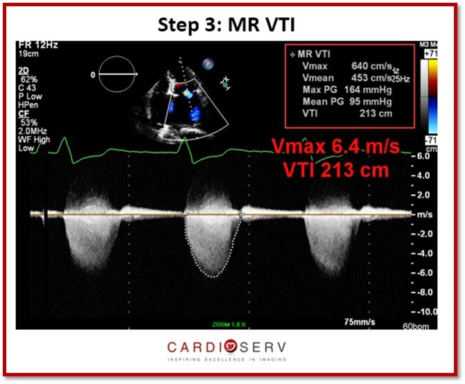 3 Steps to Quantifying MR via Stroke Volume Method!