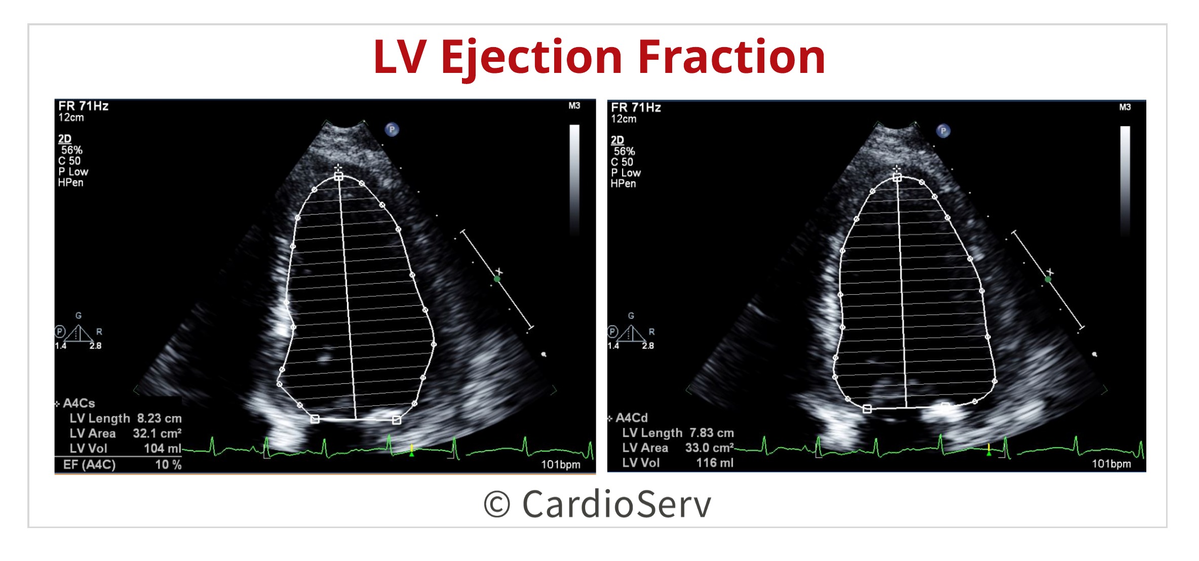 Диастолическая дисфункция Диагностер