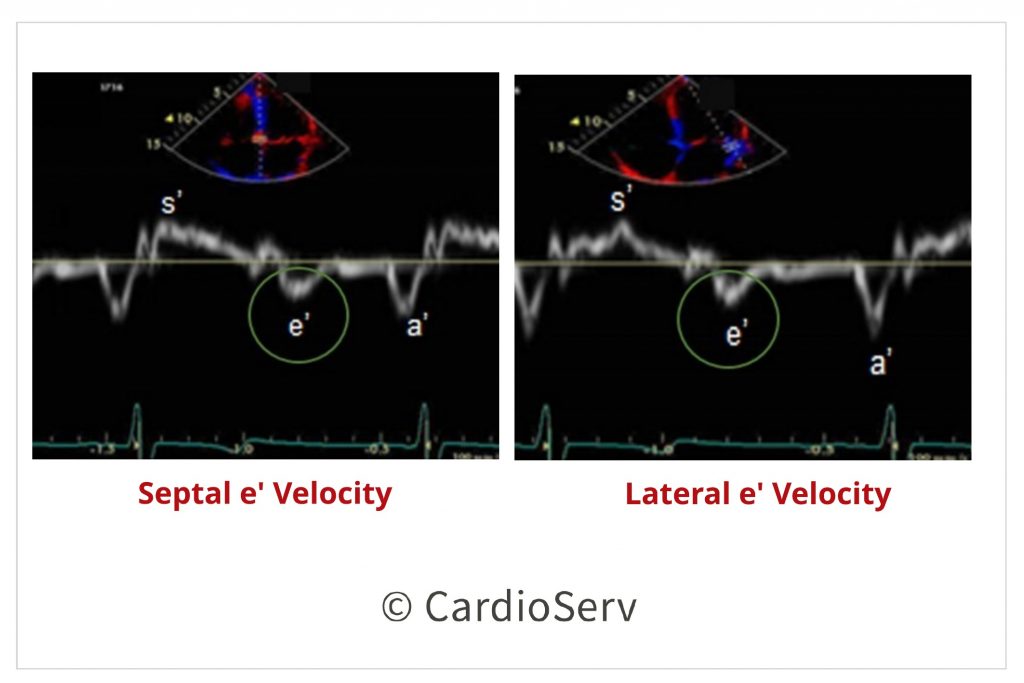 5 Steps to Identify Diastolic Dysfunction in Echo Cardioserv